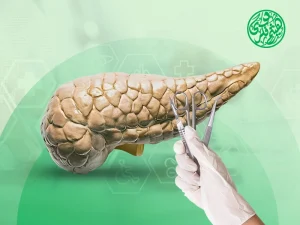 استئصال البنكرياس