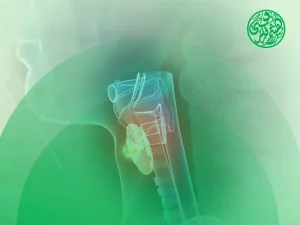 سرطان البلعوم والحنجرة