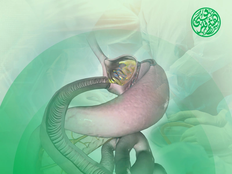 عملية تحويل مسار المعدة
