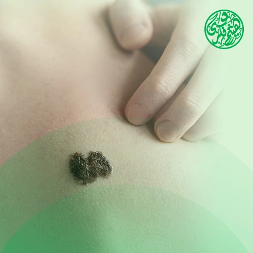 شكل سرطان الجلد